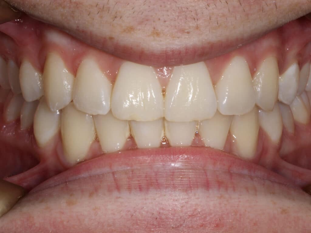 After treatment