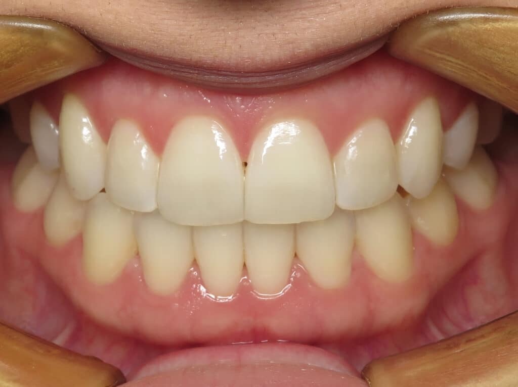 After treatment